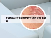 中国基因治疗银屑病的研究 基因检测 银屑病
