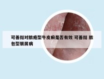 可善挺对脓疱型牛皮癣是否有效 可善挺 脓包型银屑病