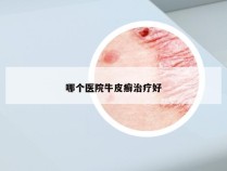 哪个医院牛皮癣治疗好