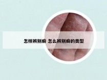 怎样辨别癣 怎么辨别癣的类型