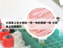 小孩身上长小米粒一块一块的像癣一样 小孩身上长癣图片