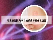 牛皮癣任何光疗 牛皮癣光疗用什么仪器