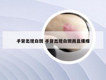 手背出现白斑 手背出现白斑而且瘙痒