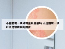 小腿前有一块红斑是银屑病吗 小腿前有一块红斑是银屑病吗图片