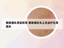银屑病头发竖状发 银屑病长头上怎治疗头发很长