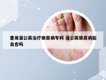 重用蒲公英治疗银屑病专利 蒲公英银屑病能自愈吗