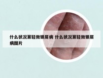 什么状况算轻微银屑病 什么状况算轻微银屑病图片