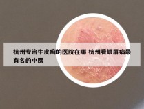 杭州专治牛皮癣的医院在哪 杭州看银屑病最有名的中医