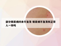 部分银屑病终身不复发 银屑病不复发和正常人一样吗