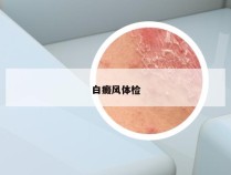 白癜风体检