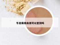 牛皮癣用血液可以查到吗
