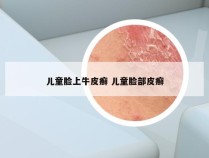 儿童脸上牛皮癣 儿童脸部皮癣