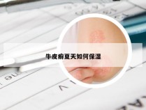 牛皮癣夏天如何保湿