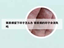 银屑病留下印子怎么办 银屑病的印子会消失吗