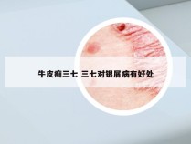 牛皮癣三七 三七对银屑病有好处
