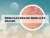 银屑病小红点中间有水泡吗 银屑病小红点中间有水泡吗