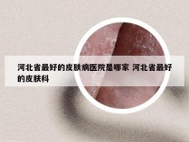 河北省最好的皮肤病医院是哪家 河北省最好的皮肤科