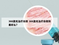 308激光治疗白斑 308激光治疗白斑效果好么?