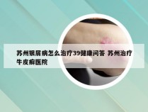 苏州银屑病怎么治疗39健康问答 苏州治疗牛皮癣医院