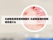 头部银屑病发病初期图片 头部银屑病的初期症状是什么