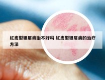 红皮型银屑病治不好吗 红皮型银屑病的治疗方法
