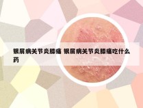 银屑病关节炎膝痛 银屑病关节炎膝痛吃什么药