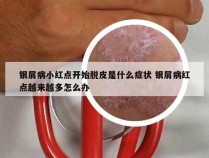 银屑病小红点开始脱皮是什么症状 银屑病红点越来越多怎么办