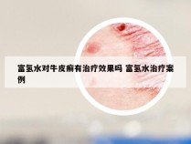 富氢水对牛皮癣有治疗效果吗 富氢水治疗案例