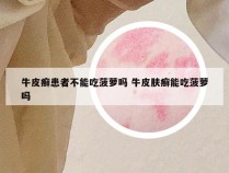 牛皮癣患者不能吃菠萝吗 牛皮肤癣能吃菠萝吗