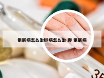 银屑病怎么治脚病怎么治 脚 银屑病
