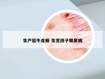 生产后牛皮癣 生完孩子银屑病