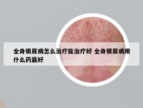 全身银屑病怎么治疗能治疗好 全身银屑病用什么药最好
