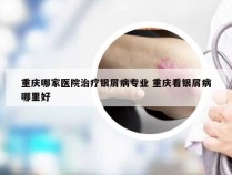 重庆哪家医院治疗银屑病专业 重庆看银屑病哪里好