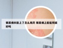 银屑病长脸上了怎么用药 银屑病上脸能彻底好吗