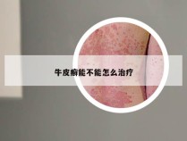 牛皮癣能不能怎么治疗