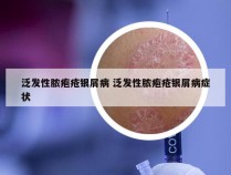 泛发性脓疱疮银屑病 泛发性脓疱疮银屑病症状