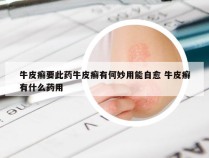 牛皮癣要此药牛皮癣有何妙用能自愈 牛皮癣有什么药用