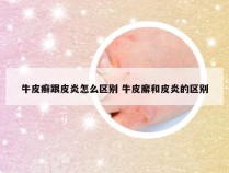 牛皮癣跟皮炎怎么区别 牛皮廨和皮炎的区别