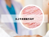 头上牛皮癣偏方治疗