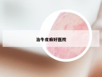 治牛皮癣好医院