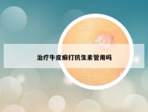 治疗牛皮癣打抗生素管用吗