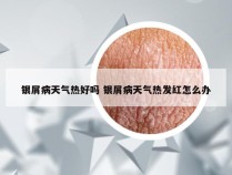 银屑病天气热好吗 银屑病天气热发红怎么办