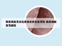 银屑病复发会在原来皮损处复发吗 银屑病越复发越轻