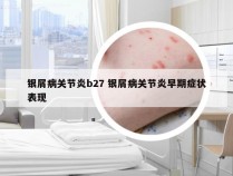 银屑病关节炎b27 银屑病关节炎早期症状表现