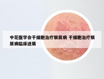 中花医学会干细胞治疗银屑病 干细胞治疗银屑病临床进展