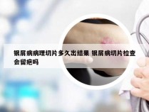银屑病病理切片多久出结果 银屑病切片检查会留疤吗