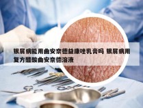 银屑病能用曲安奈德益康唑乳膏吗 银屑病用复方醋酸曲安奈德溶液