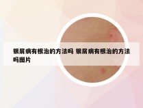银屑病有根治的方法吗 银屑病有根治的方法吗图片