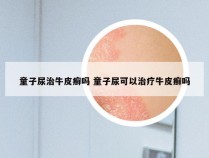 童子尿治牛皮癣吗 童子尿可以治疗牛皮癣吗