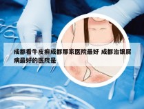 成都看牛皮癣成都那家医院最好 成都治银屑病最好的医院是